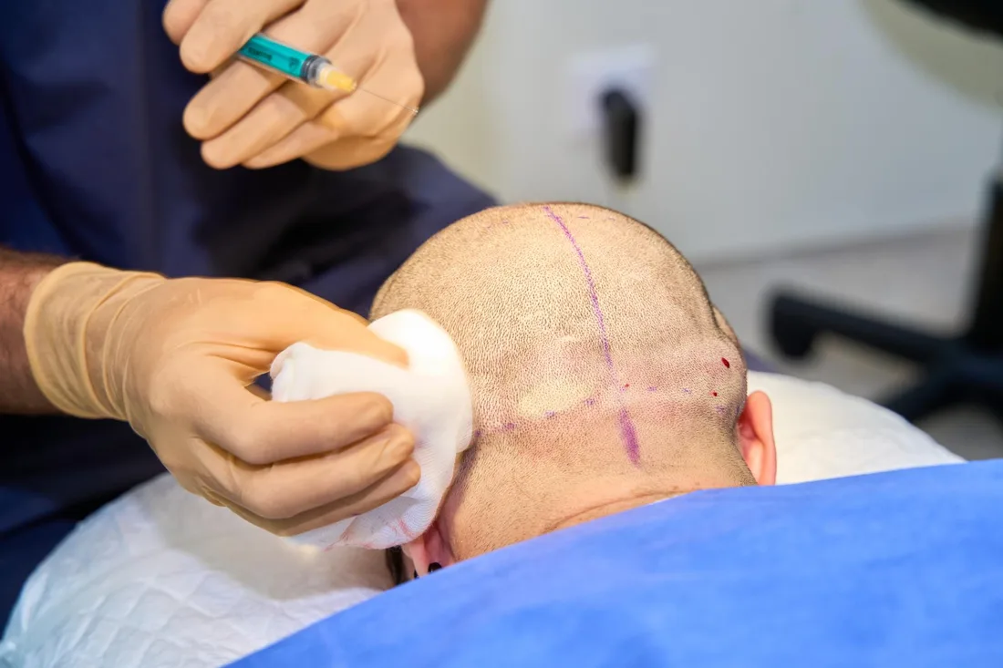 PRP & donor preparation