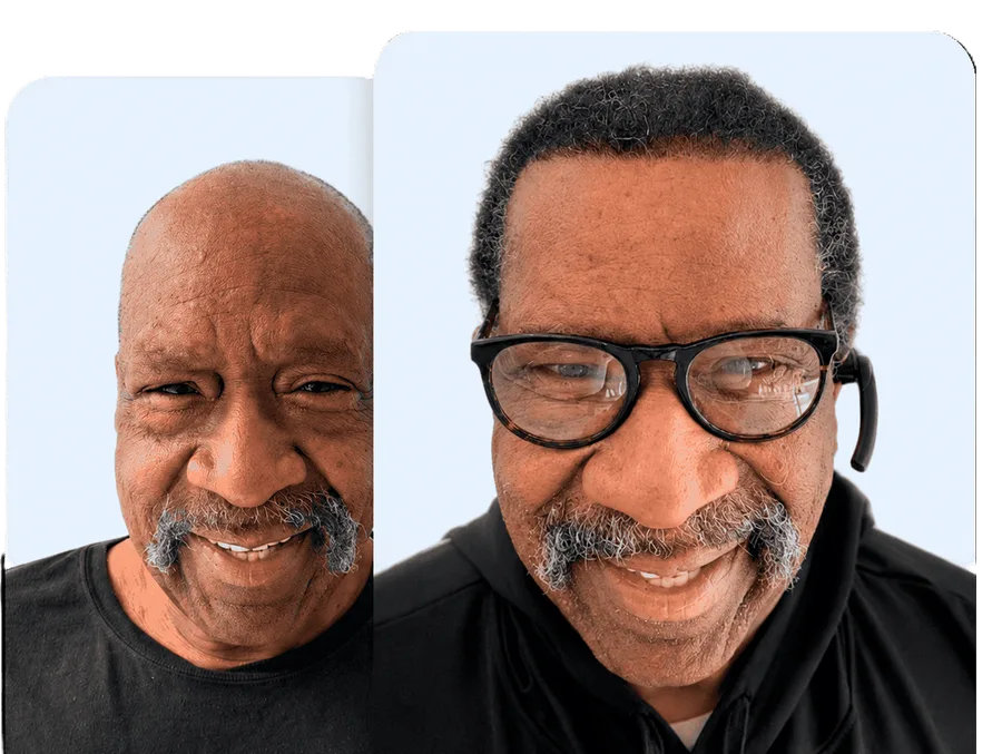 Before and after hair restoration