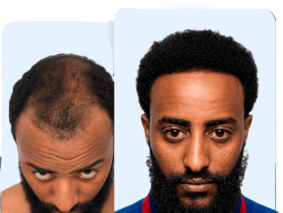 Before and after — Hairline restoration