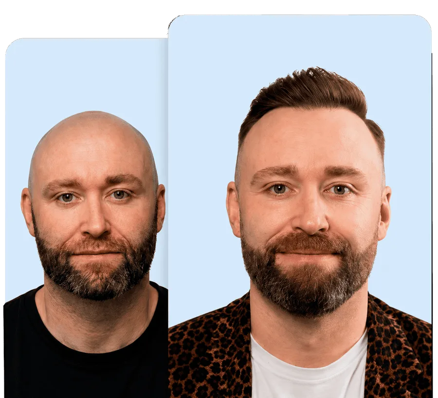 Before and after — Hairline & density