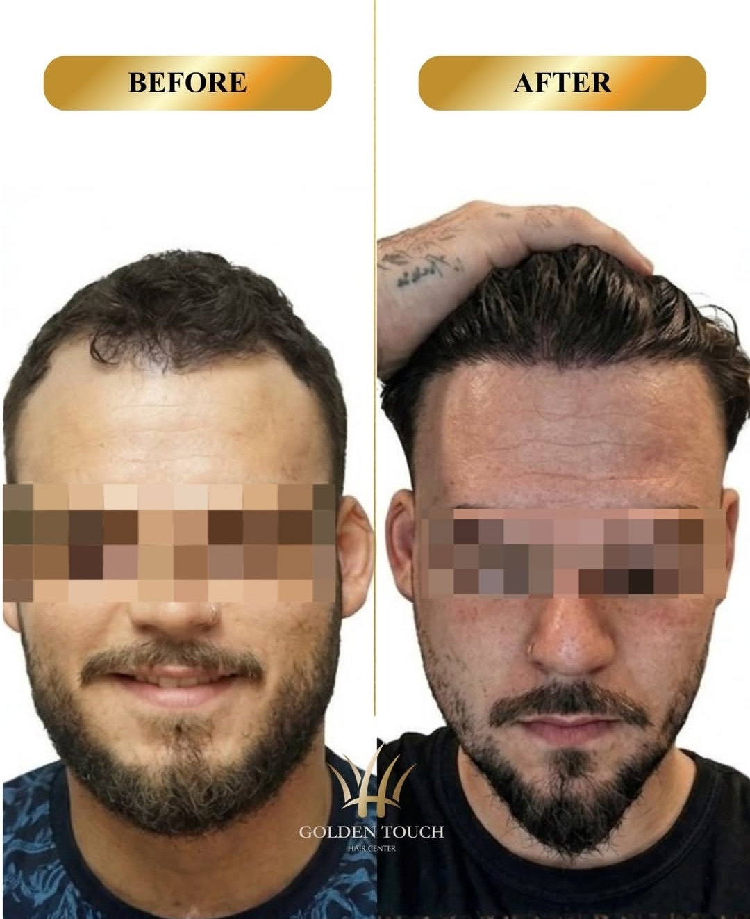 Before and after hair restoration
