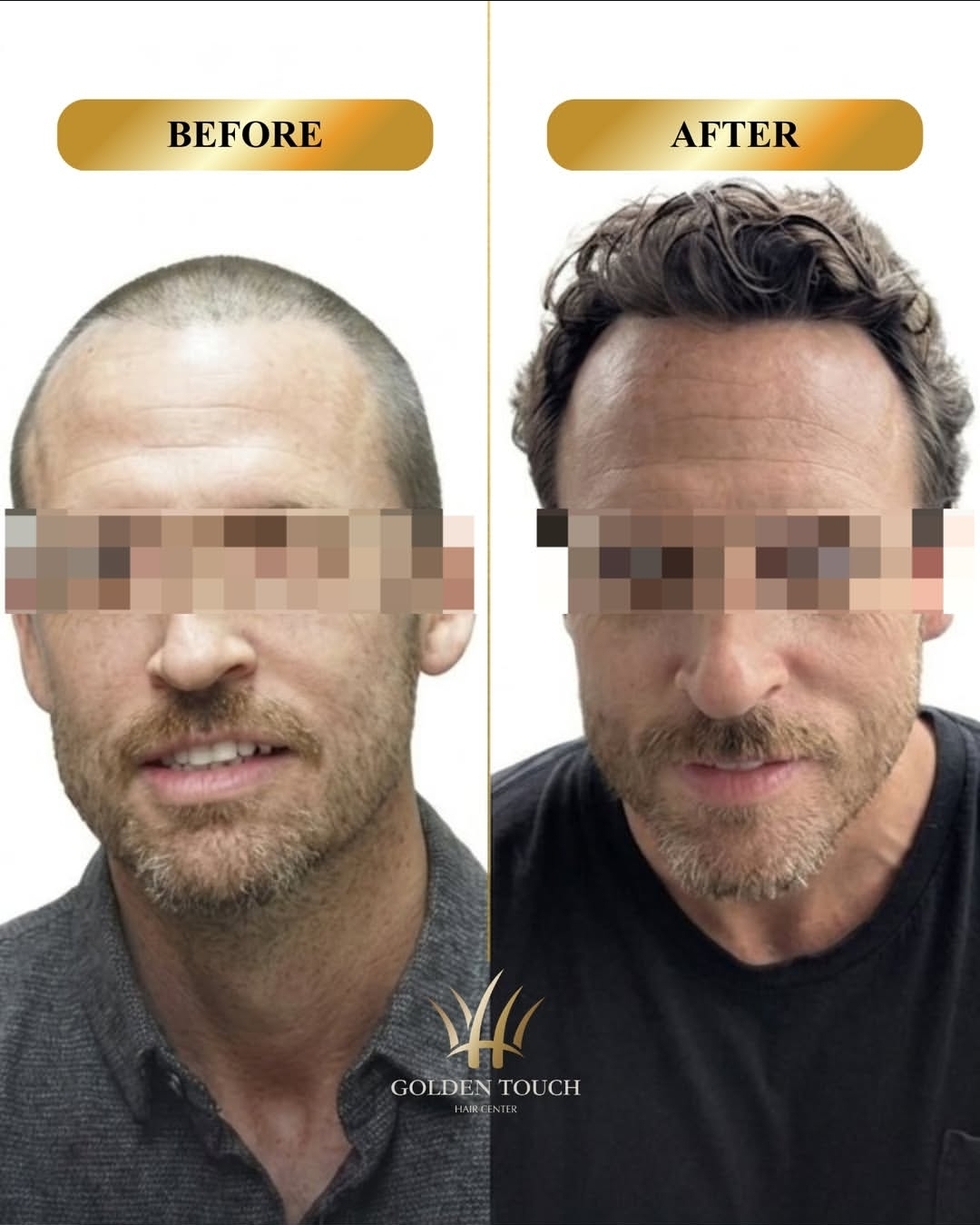 Before and after hair restoration